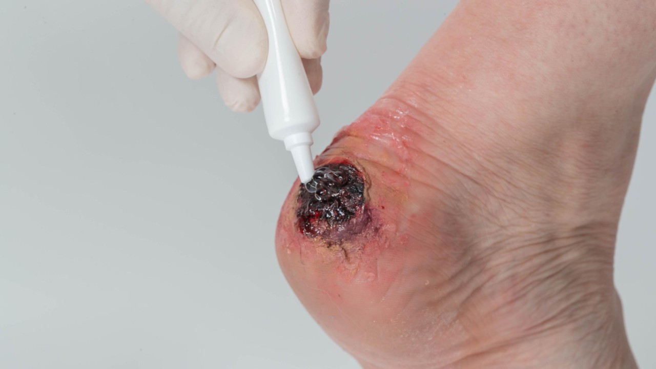 Person with a wound on their foot applying the wound care product Amorphous Hydrogel